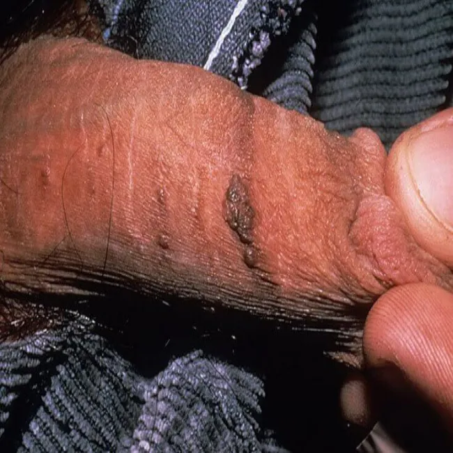 Zdjęcia chorób wenerycznych u mężczyzn grudkowatość bowenoidalna 