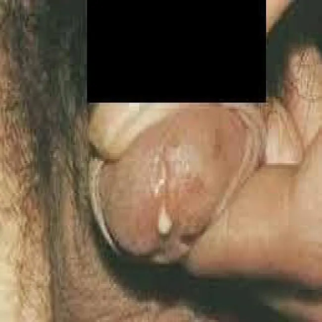 Zdjęcia chorób wenerycznych u mężczyzn