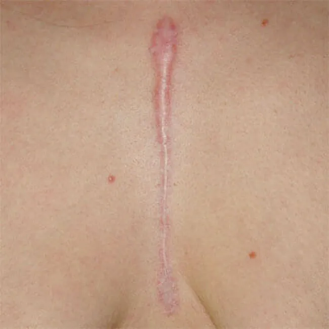 Zdjęcie bliznowce po operacji