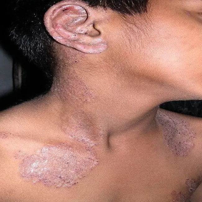 Zdjęcie grzybica skóry odzwierzęca u dziecka