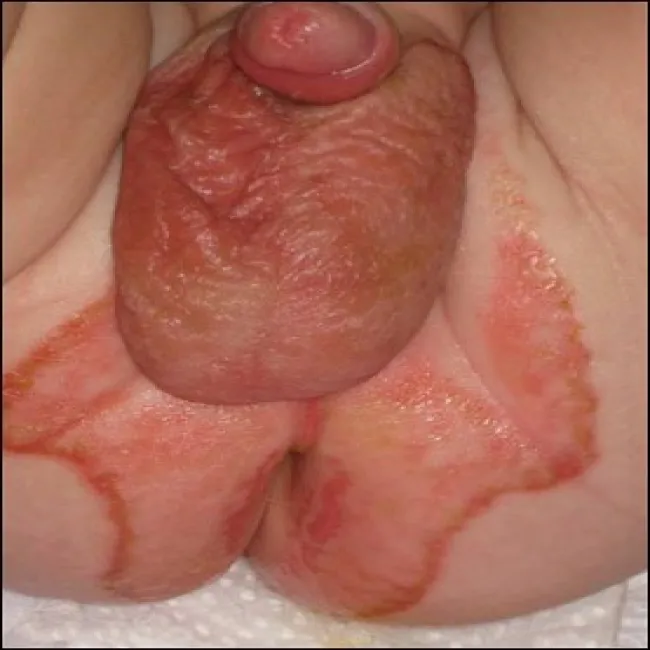 Zespół Danbolta-Clossa zdjęcie