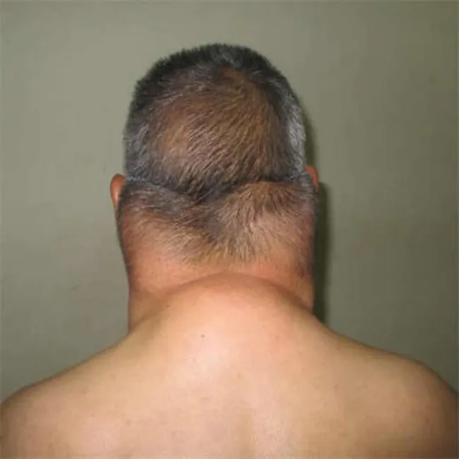 Zespół Launois-Bensaude 