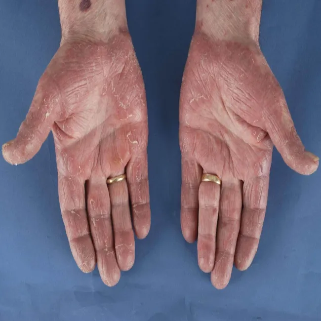 Zespół Sezary’ego na dłoniach 