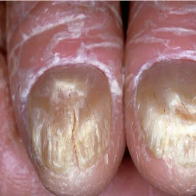 Zespół Sezary’ego na palcach, paznokciach