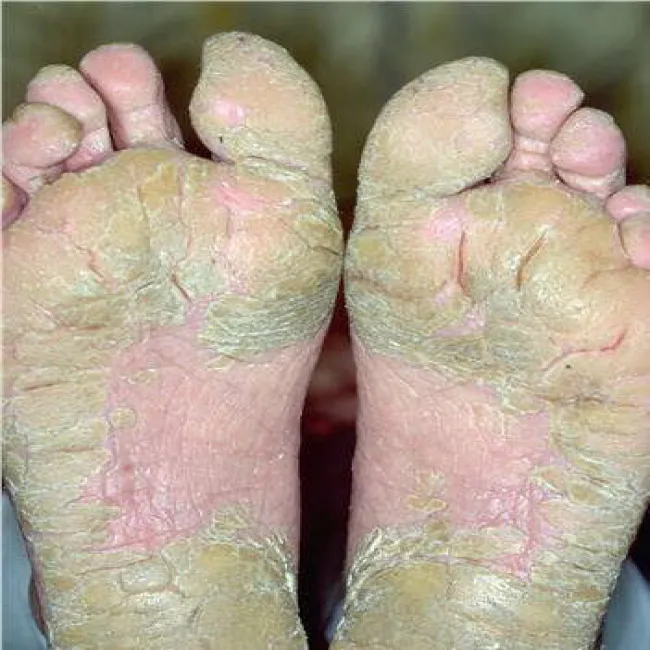 Zespół Sezary’ego na stopach