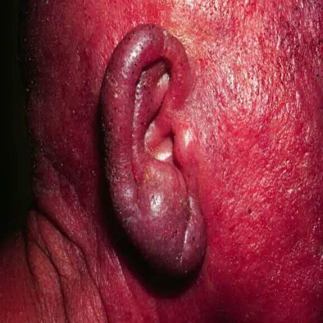 Zespół Sezary’ego wygląd