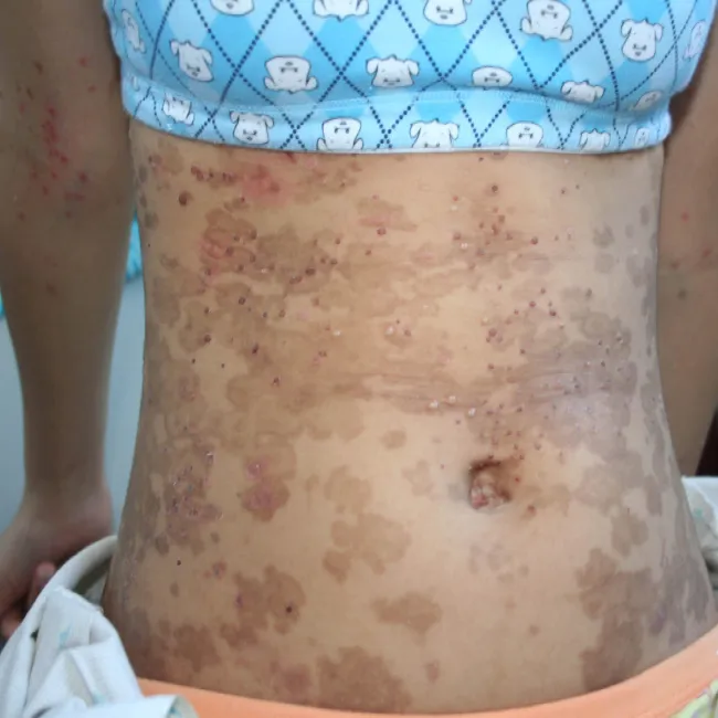 Zespół Sneddona objawy