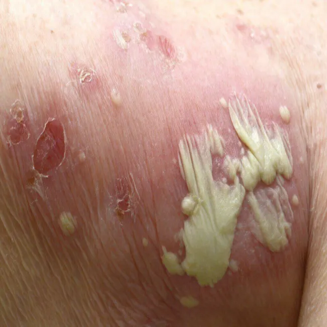 Zespół Sneddona zdjęcie