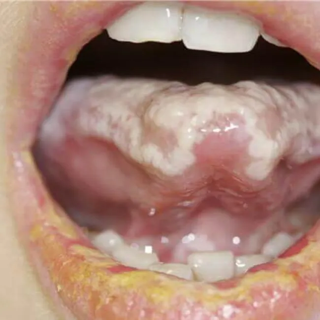 Zespół Stevensa- Johnsona na języku