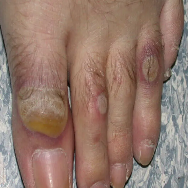 Zespół Stevensa- Johnsona na stopie