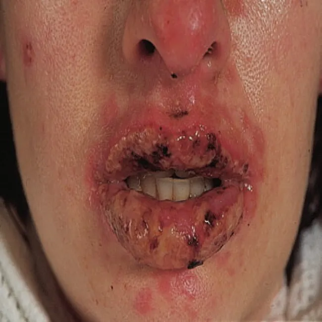 Zespół Stevensa- Johnsona na ustach
