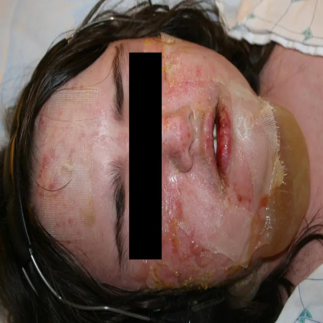 Zespół Stevensa- Johnsona objawy na twarzy