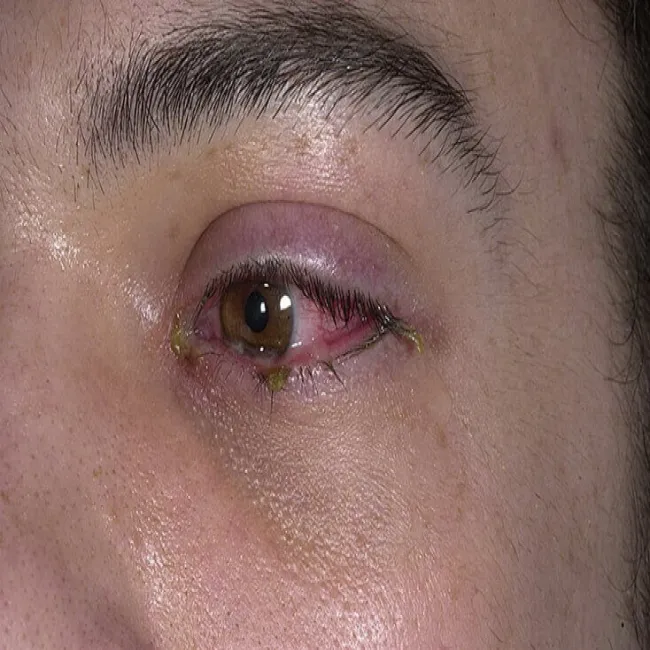 Zespół Stevensa- Johnsona oka