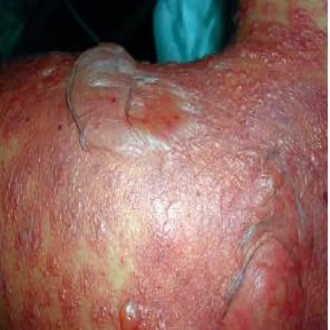 Zespół oparzonej skóry