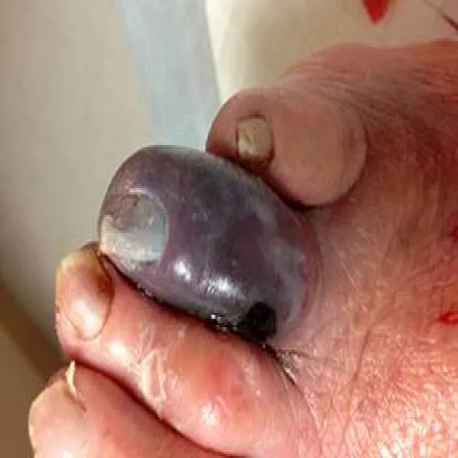 Zgorzel gazowa gangrena na palcu