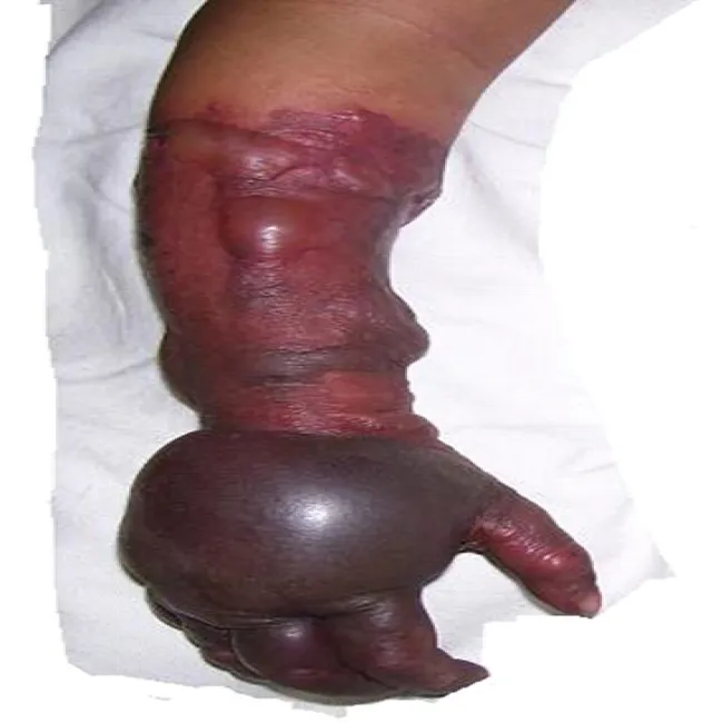 Zgorzel gazowa gangrena na ręce