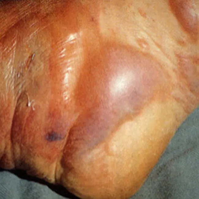 Zgorzel gazowa gangrena na stopie