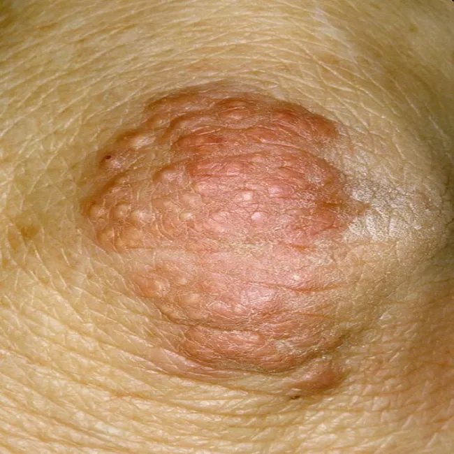 Zgrubienie na łokciu pod skórą kępki żółte guzkowe 