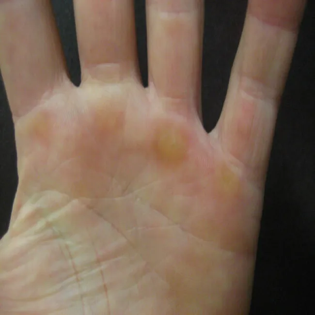 Zgrubienie skóry na dłoni