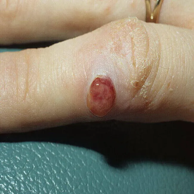 Ziarniniak naczyniowy na palcu