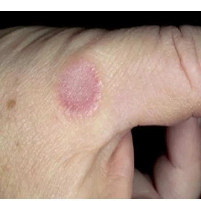 Ziarniniak obrączkowaty na palcu