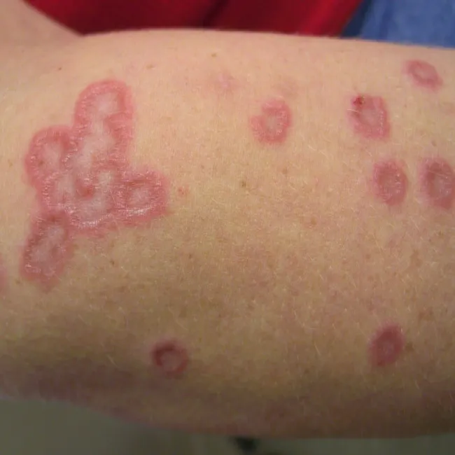 Ziarniniak obrączkowaty objawy skórne