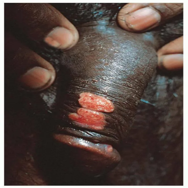 Ziarniniak pachwinowy donowanoza