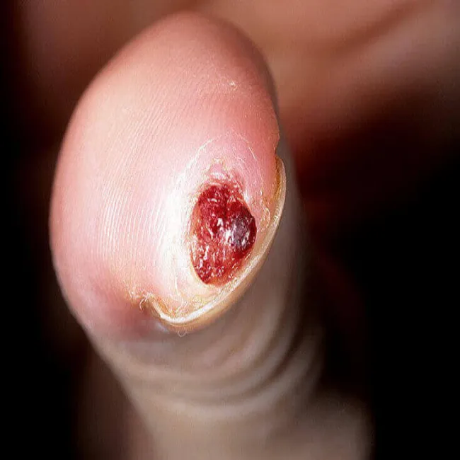 Ziarniniak pod paznokciem