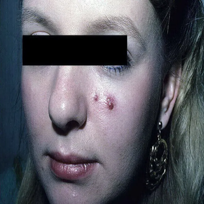 Ziarniniak ropotwórczy guzki na twarzy