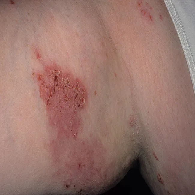 Zmiany skórne pod pachą choroba Haileya-Haileya 