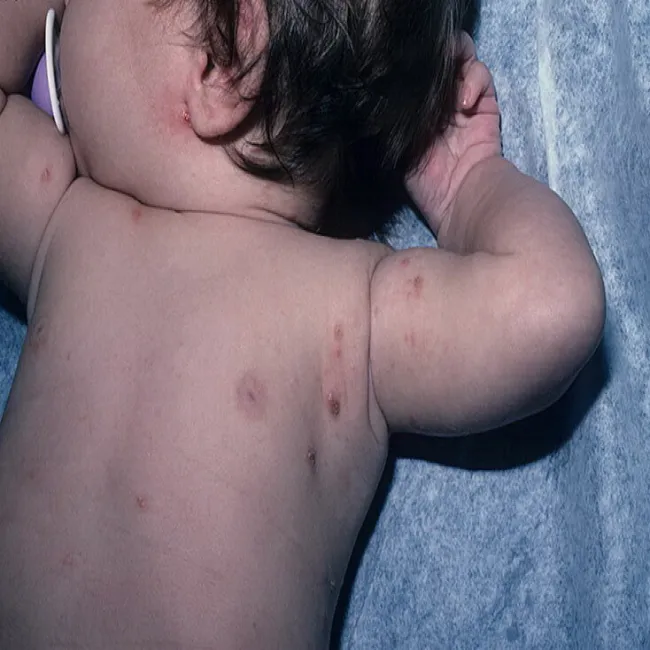 Zmiany skórne grudki choroba świerzb