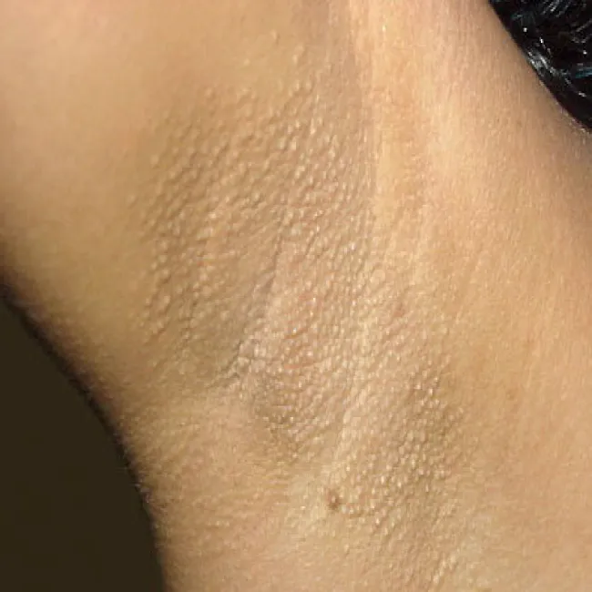 Zmiana koloru skóry pod pachami choroba Foxa-Fordyce'a