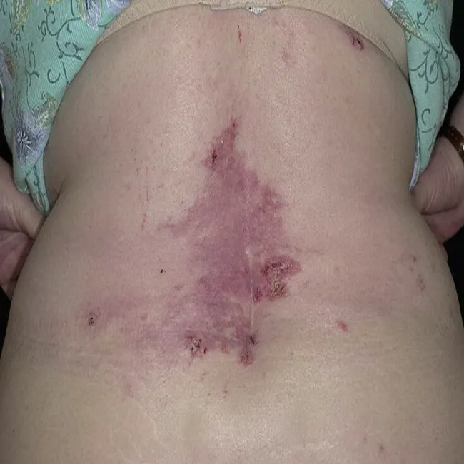 Zmiana skórna na brzuchu choroba Haileya-Haileya