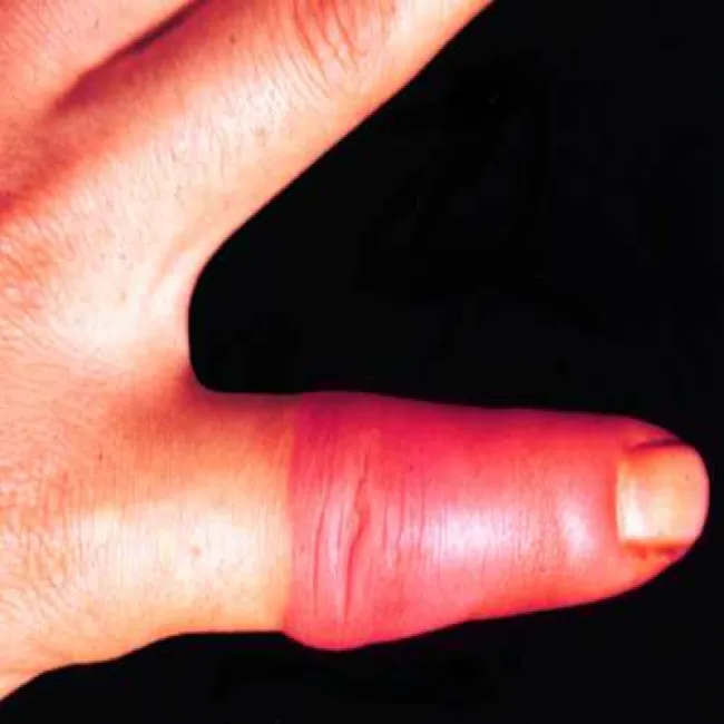 Zmiana skórna na palcu różyca 