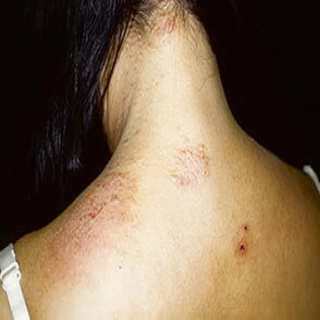 Zmiana skórna na szyi wyprysk pieniążkowaty