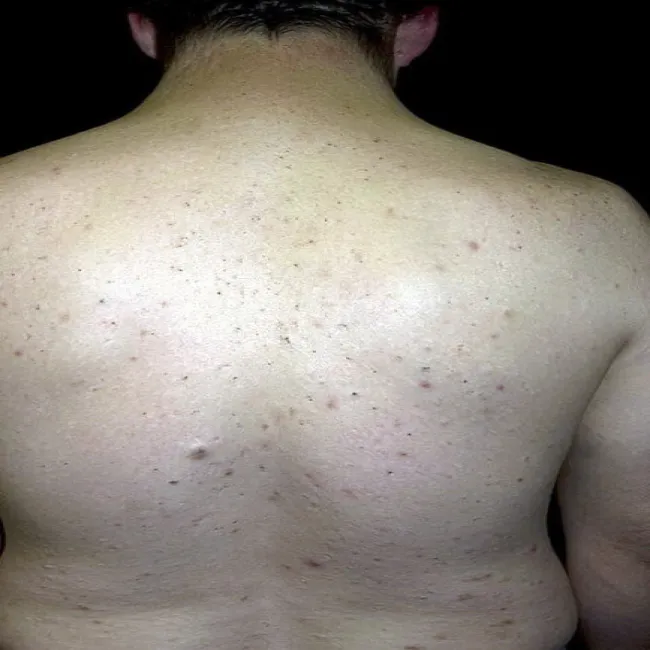 Zmiana skórna wągry