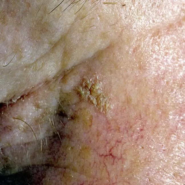 Zmiana starcza na skórze koło oka