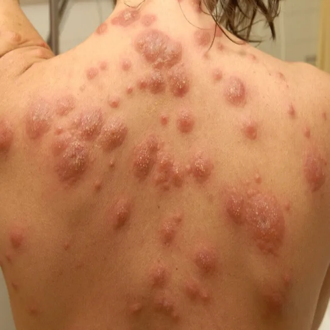 Zmiany grudkowe skóry na plecach 
