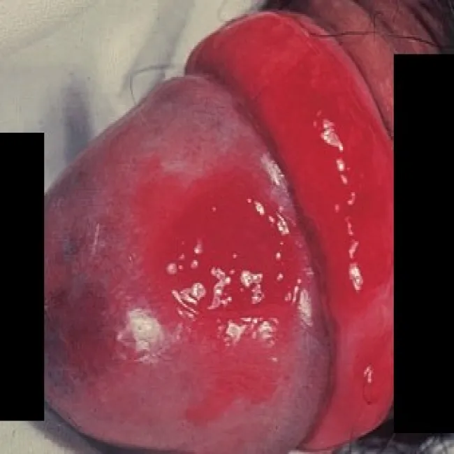 Zmiany na napletku i członku erytroplazja Queyrata