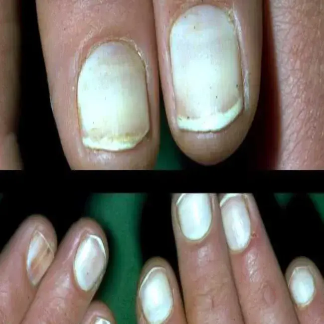 Zmiany na paznokciach białe paznokcie