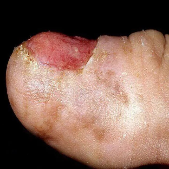 Zmiany na paznokciach choroba czerniak