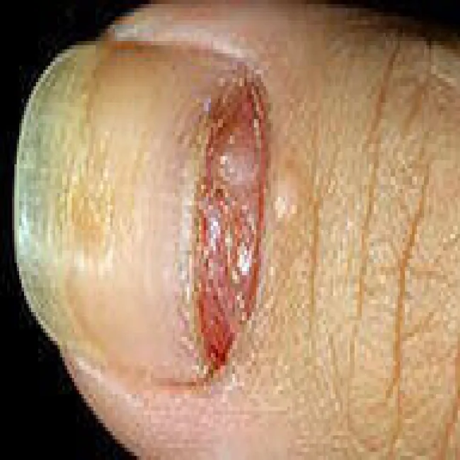 Zmiany na paznokciu czerniak paznokcia