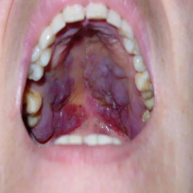 Zmiany na podniebieniu mięsak Kaposiego 