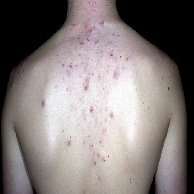 Zmiany na skórze pleców zaskórniki otwarte