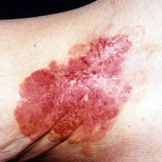 Zmiany na skórze pozasutkowa choroba Pageta 