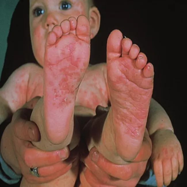 Zmiany na stopach u dziecka świerzb