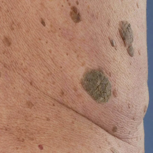 Zmiany skórne brodawki łojotokowe