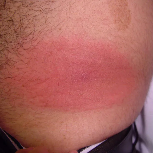 Zmiany skórne borelioza