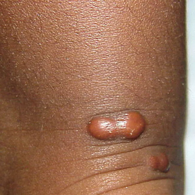 Zmiany skórne guzki kępki żółte guzowate