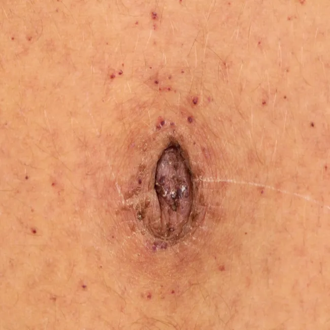 Zmiany skórne koło pępka choroba Fabry'ego